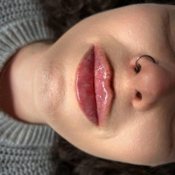 Lip filler11