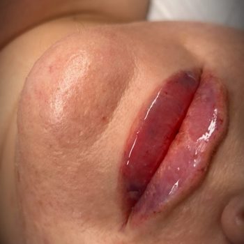 Lip filler10