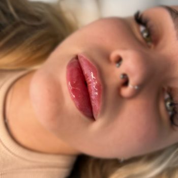 Lip filler9