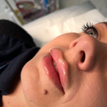 Lip filler7
