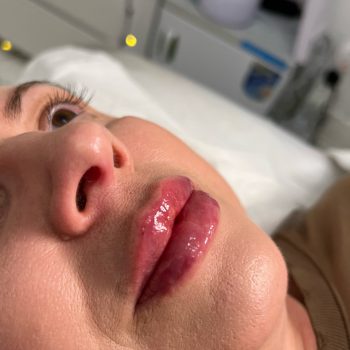 Lip filler6