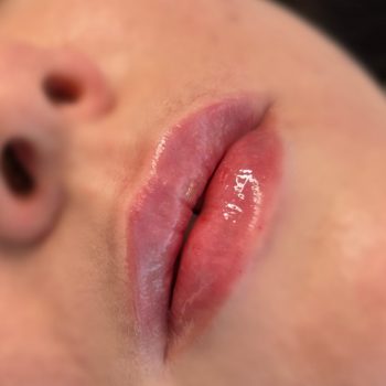 Lip filler5