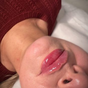 Lip filler4