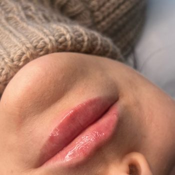 Lip filler3