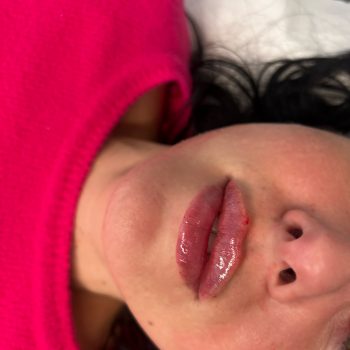 Lip filler2