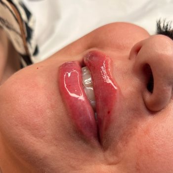 Lip filler1
